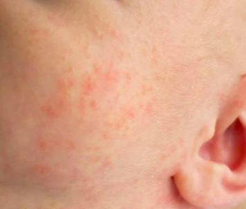 Как проявляется аллергия при прикорме фото thumbnail
