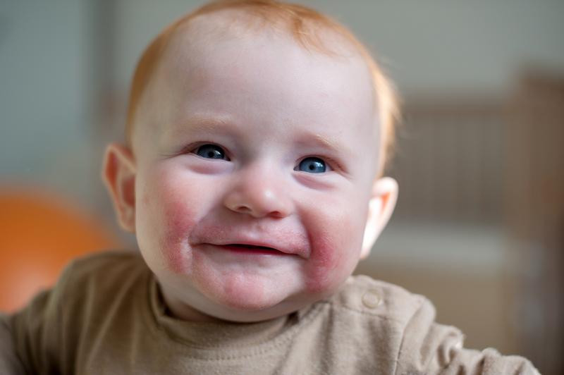 Ребенку 2 месяца аллергия что пить thumbnail
