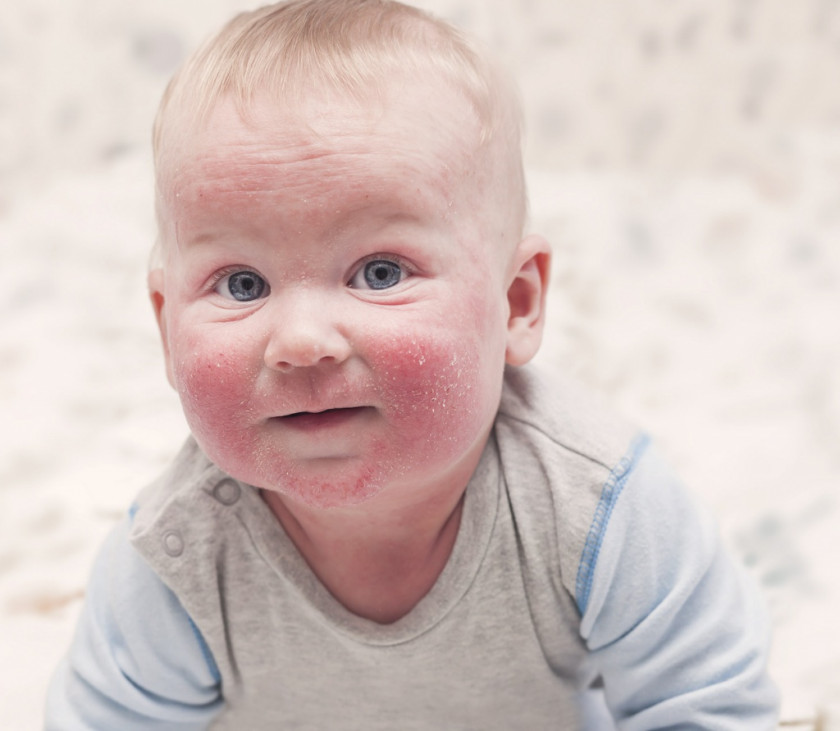 Аллергия на лактозу у малыша
