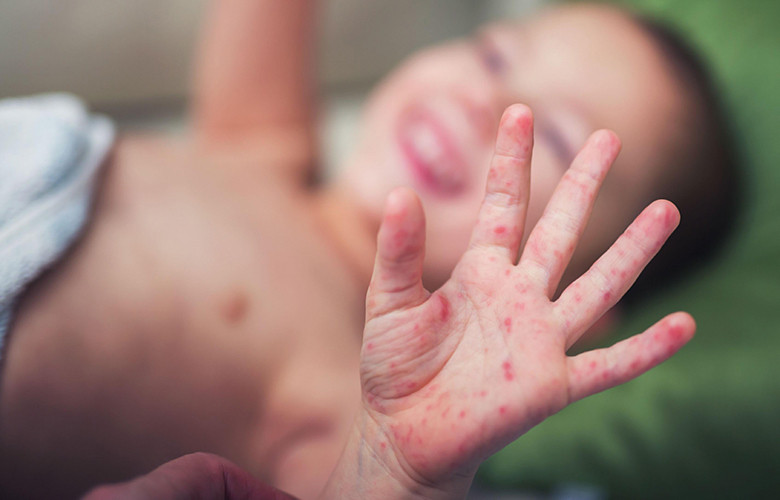 Энтеровирусная инфекция у детей — симптомы и лечение